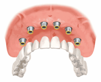Computer guided dental implant placement animation