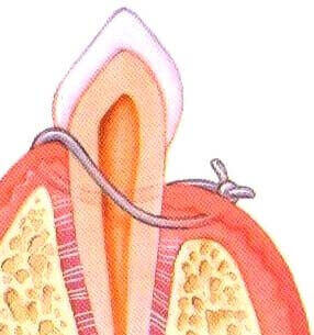 Post-treatment results of pocket reduction surgery