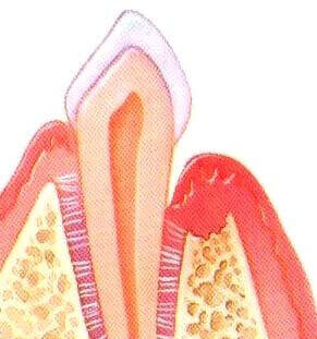 Step 2 of pocket reduction treatment for gum disease