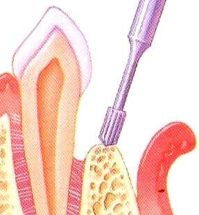 Step 4 of periodontal pocket reduction therapy