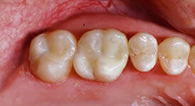 After direct dental restoration procedure results