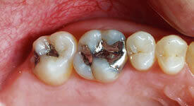 Before direct dental restoration procedure for damaged teeth