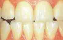 After indirect dental restoration treatment showing healthy teeth