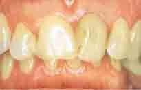 Before indirect dental restoration treatment at DentiCare India