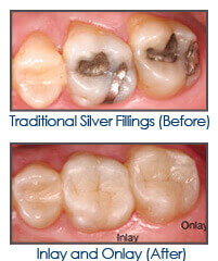 Close-up of customized dental inlay and onlay procedure