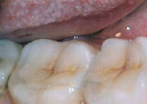 Post-operative results of inlay and onlay restoration