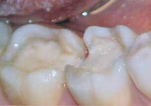 Pre-operative view for dental inlay and onlay treatment