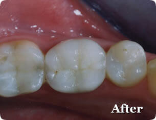 After inlay and onlay dental restoration treatment