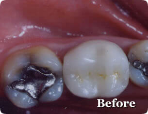Before inlay and onlay dental restoration treatment