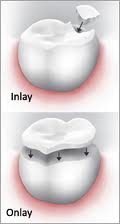 Overview of inlay and onlay dental restorations