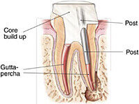 Post and core build up dental procedure illustration
