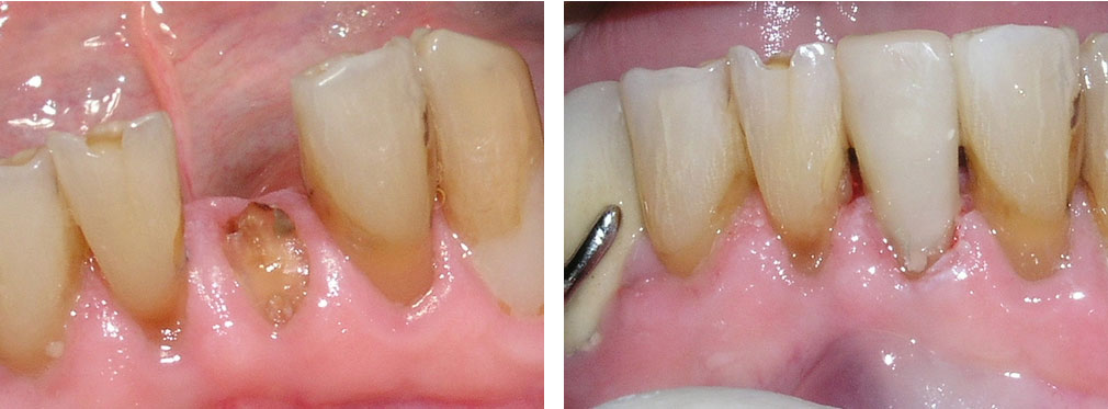 Post and core buildup treatment process step