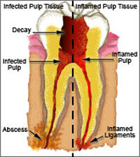 Pulp Capping Denticare Direct and indirect pulp capping dental procedure illustration