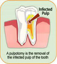 Pulpotmony Denticare Pulpotomy dental treatment process for children and adults