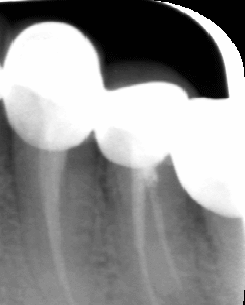 Diagram showing two root canals in multi-rooted root canal therapy