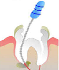 After successful laser-assisted root canal therapy treatment at DentiCare