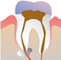 Before laser-assisted root canal therapy treatment at DentiCare