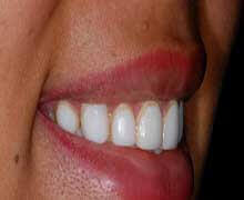 Direct composite veneers procedure example at DentiCare India