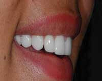 Indirect porcelain veneers application process at DentiCare India