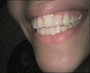 Teeth after ceramic veneers treatment transformation