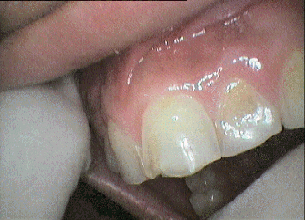 Teaches before ceramic veneers treatment