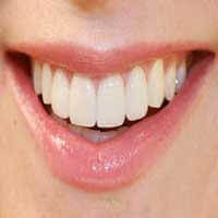 Ceramic Veneers - Denticare