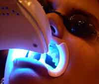 Advanced laser teeth whitening procedure results