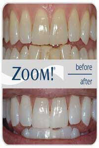 Zoom teeth whitening treatment session