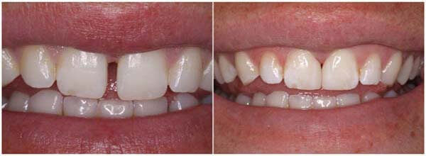 Before and after diastema closure gap teeth treatment