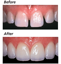 Diastema closure treatment animation procedure