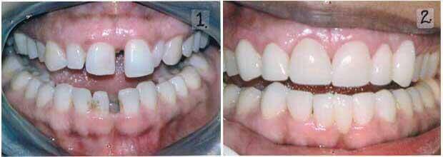 Teeth gap closure results using composite bonding