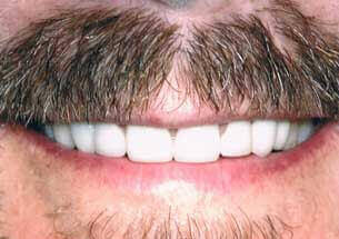 After smile design treatment results at DentiCare India