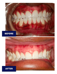Patient undergoing laser gum depigmentation treatment
