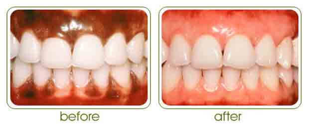 Before and after results of laser depigmentation of gums