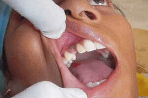 Before dental implant exposure treatment patient case at DentiCare India