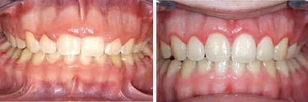 Gingivectomy gum contouring procedure at DentiCare India