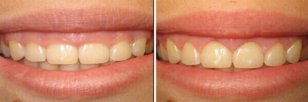 Professional gingivectomy surgery setup and care