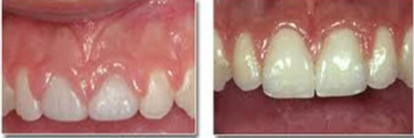 Professional gingivoplasty gum reshaping procedure at DentiCare India