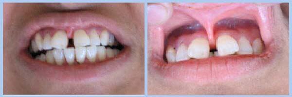 Professional frenectomy dental procedure at DentiCare India