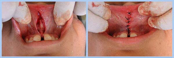 Laser frenectomy treatment session at DentiCare India clinic