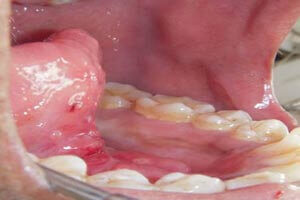After lingual frenectomy successful recovery result