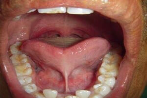 Before lingual frenectomy tongue-tie condition patient case