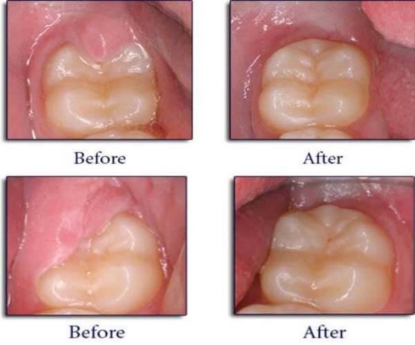 Operculectomy surgical procedure at DentiCare India