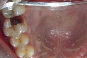 Oral polyp excision after successful treatment results