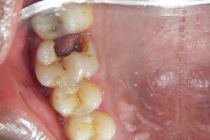 Oral polyp excision before treatment case