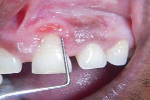 Pyogenic granuloma after successful treatment results