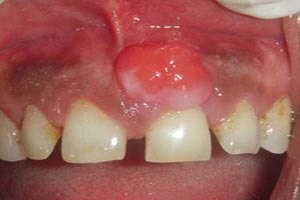 Pyogenic granuloma before treatment patient case