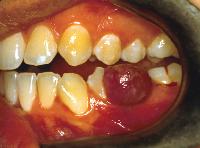 Pyogenic granuloma dental treatment procedure at DentiCare India