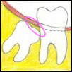 Disimpaction Angular - Denticare