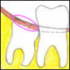 Tissue Disimpaction - Denticare